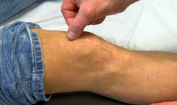 Científicos descubren que un químico natural puede curar heridas el doble de rápido que los antibióticos
