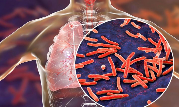 Declaran emergencia de salud pública por un brote local de tuberculosis en EE.UU.